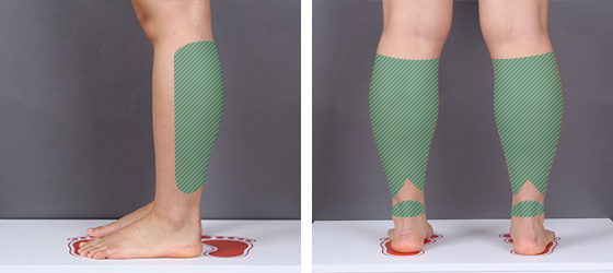 허벅지 지방흡입 수술 전