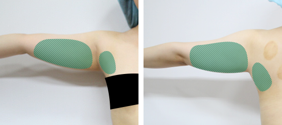 허벅지 지방흡입 수술 전