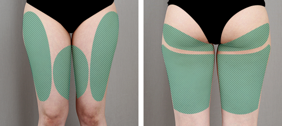 허벅지 지방흡입 수술 전